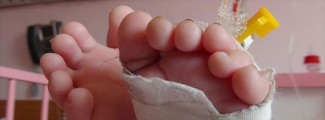 Kızıltepe´de 24 parmaklı bebek görenleri şaşırttı