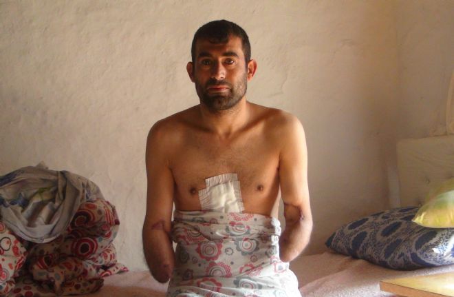 İki kolunu kaybeden inşaat işçisi, protez kol hayali kuruyor